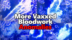 More #ClotShot Bloodwork Analysis: Another Doctor Blows Whistle On Post-Vaccine Anomalies
