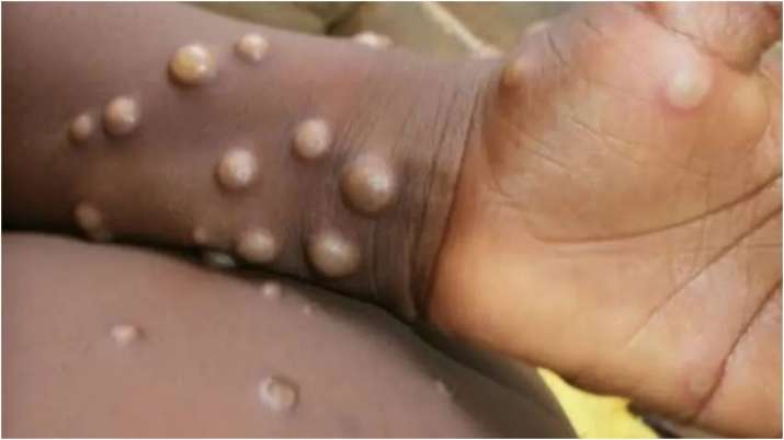 Belgium becomes world's first nation to mandate 21-day quarantine for Monkeypox